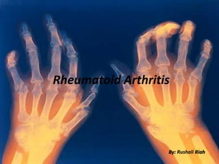 Rheumatoid Arthritis
By: Rushali Riah
 