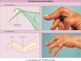 Extra-articular
            manifestations
    Present in 30-40%
   May occur prior to arthritis
   Patients that are m...
