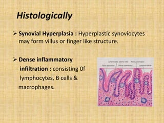 Histologically
 Synovial Hyperplasia : Hyperplastic synoviocytes
may form villus or finger like structure.
 Dense inflammatory
infiltration : consisting 0f
lymphocytes, B cells &
macrophages.
 