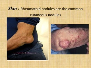 Skin : Rheumatoid nodules are the common
cutaneous nodules
 