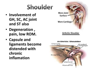 rheumatoid arthritis. | PPTX