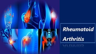 Rheumatoid
Arthritis
 