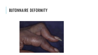 BUTONNAIRE DEFORMITY
 