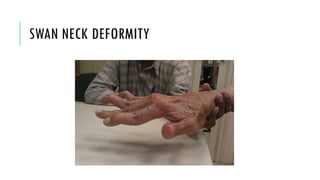 SWAN NECK DEFORMITY
 
