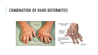 COMBINATION OF HAND DEFORMITIES
 