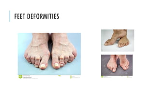 FEET DEFORMITIES
 