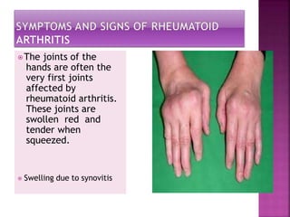 ⦿The joints of the
hands are often the
very first joints
affected by
rheumatoid arthritis.
These joints are
swollen red and
tender when
squeezed.
⦿ Swelling due to synovitis
 