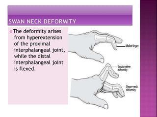 ⦿The deformity arises
from hyperextension
of the proximal
interphalangeal joint,
while the distal
interphalangeal joint
is flexed.
 
