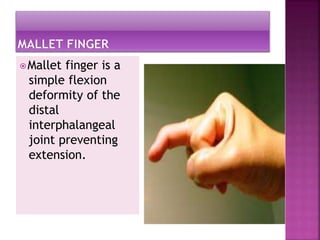 ⦿Mallet finger is a
simple flexion
deformity of the
distal
interphalangeal
joint preventing
extension.
 