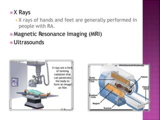 ⦿ X Rays
◾X rays of hands and feet are generally performed in
people with RA.
⦿ Magnetic Resonance Imaging (MRI)
⦿ Ultrasounds
 