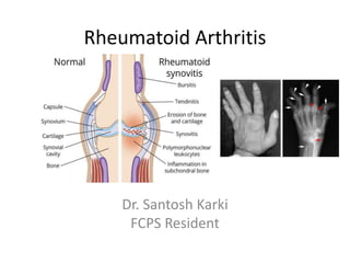 Rheumatoid Arthritis
Dr. Santosh Karki
FCPS Resident
 