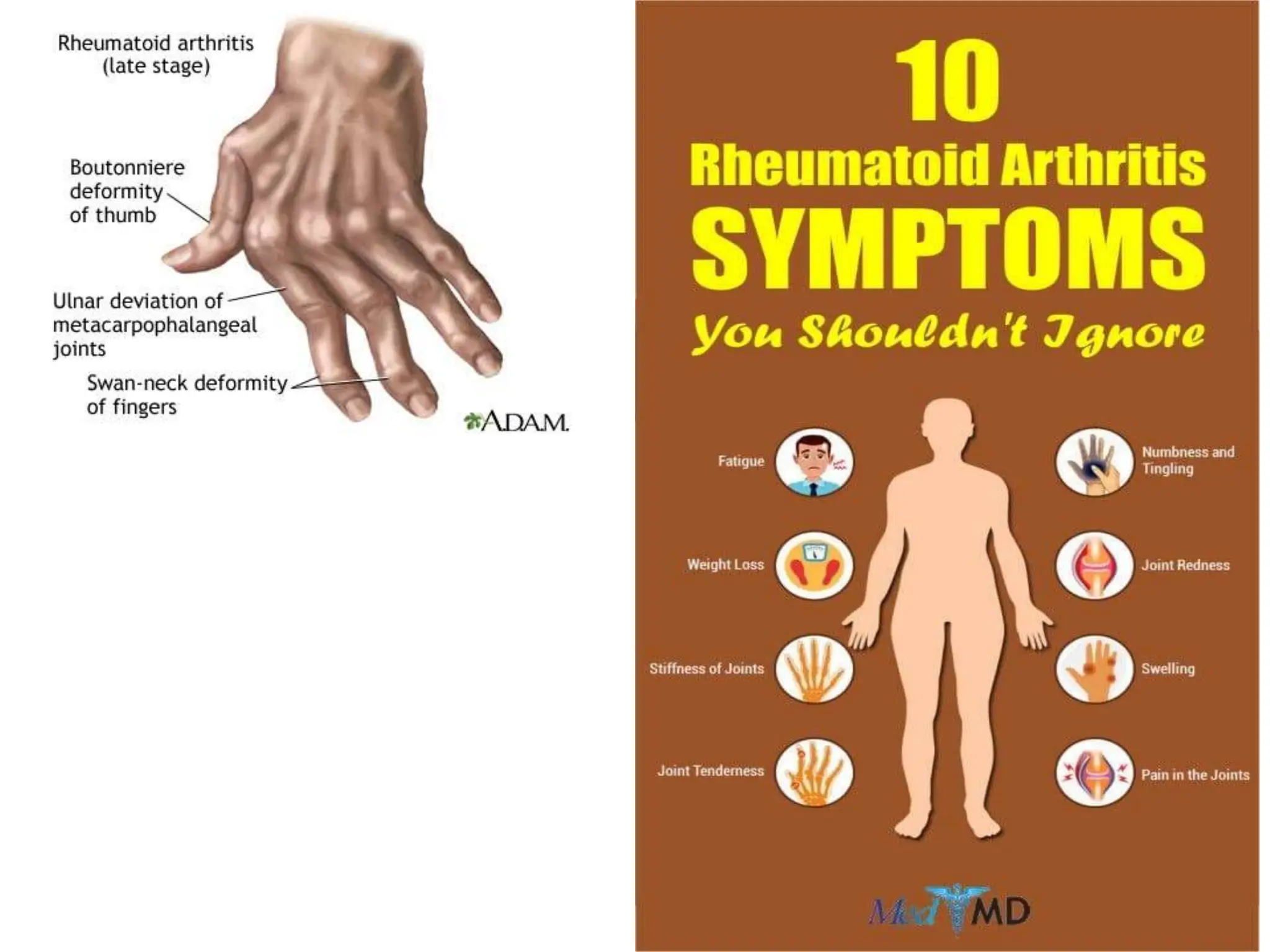 Rheumatoid arthritis - Musculoskeletal disorders.ppt