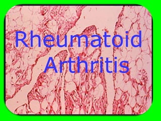 Rheumatoid
Arthritis
 