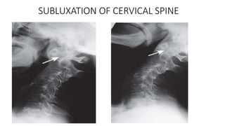 SUBLUXATION OF CERVICAL SPINE
 