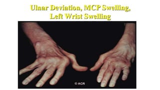 Ulnar Deviation, MCP Swelling,
Left Wrist Swelling
 