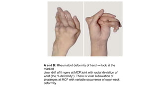 A and B: Rheumatoid deformity of hand — look at the
marked
ulnar drift of fi ngers at MCP joint with radial deviation of
wrist (the “z-deformity”). There is volar subluxation of
phalanges at MCP with variable occurrence of swan-neck
deformity
 
