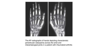 The AP radiographs of hands depicting characteristic
periarticular osteopenia across the wrist and
interphalangeal joints in a patient with rheumatoid arthritis
 