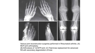 Various joint reconstruction surgeries performed in Rheumatoid arthritis. (A)
MCP joint arthroplasty;
(B) Arthrodesis of 1st MTP joint; (C) Total knee replacement for advanced
RA with secondary degeneration of knee
 