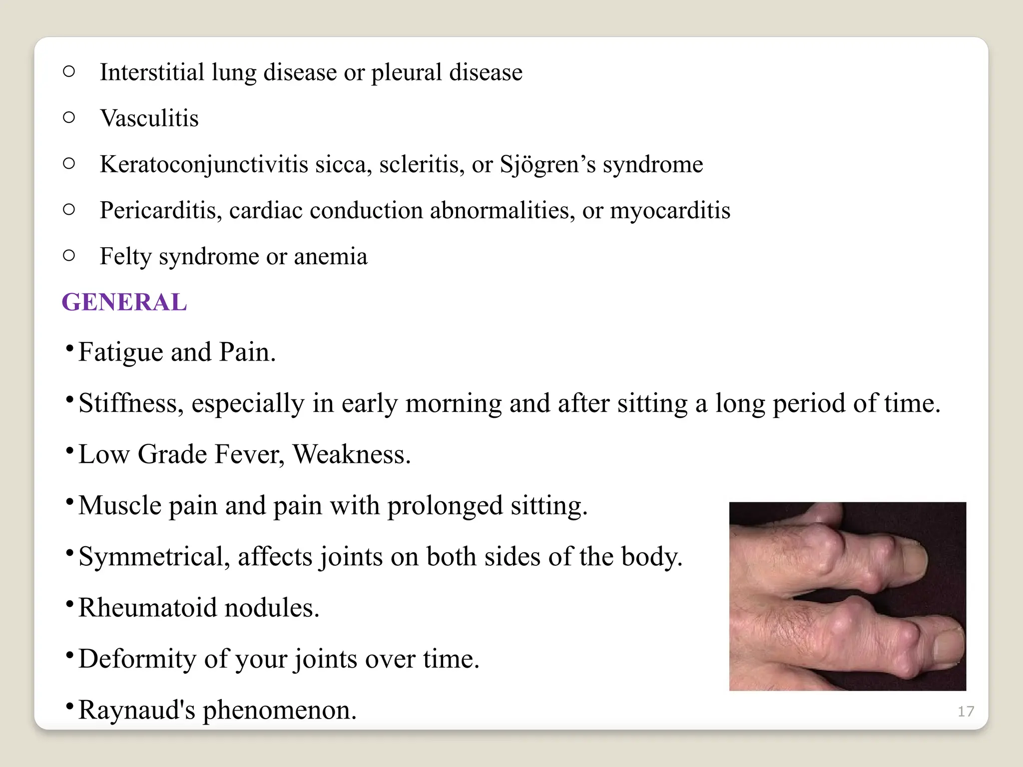 17
o Interstitial lung disease or pleural disease
o Vasculitis
o Keratoconjunctivitis sicca, scleritis, or Sjögren’s syndrome
o Pericarditis, cardiac conduction abnormalities, or myocarditis
o Felty syndrome or anemia
GENERAL
•Fatigue and Pain.
•Stiffness, especially in early morning and after sitting a long period of time.
•Low Grade Fever, Weakness.
•Muscle pain and pain with prolonged sitting.
•Symmetrical, affects joints on both sides of the body.
•Rheumatoid nodules.
•Deformity of your joints over time.
•Raynaud's phenomenon.
 