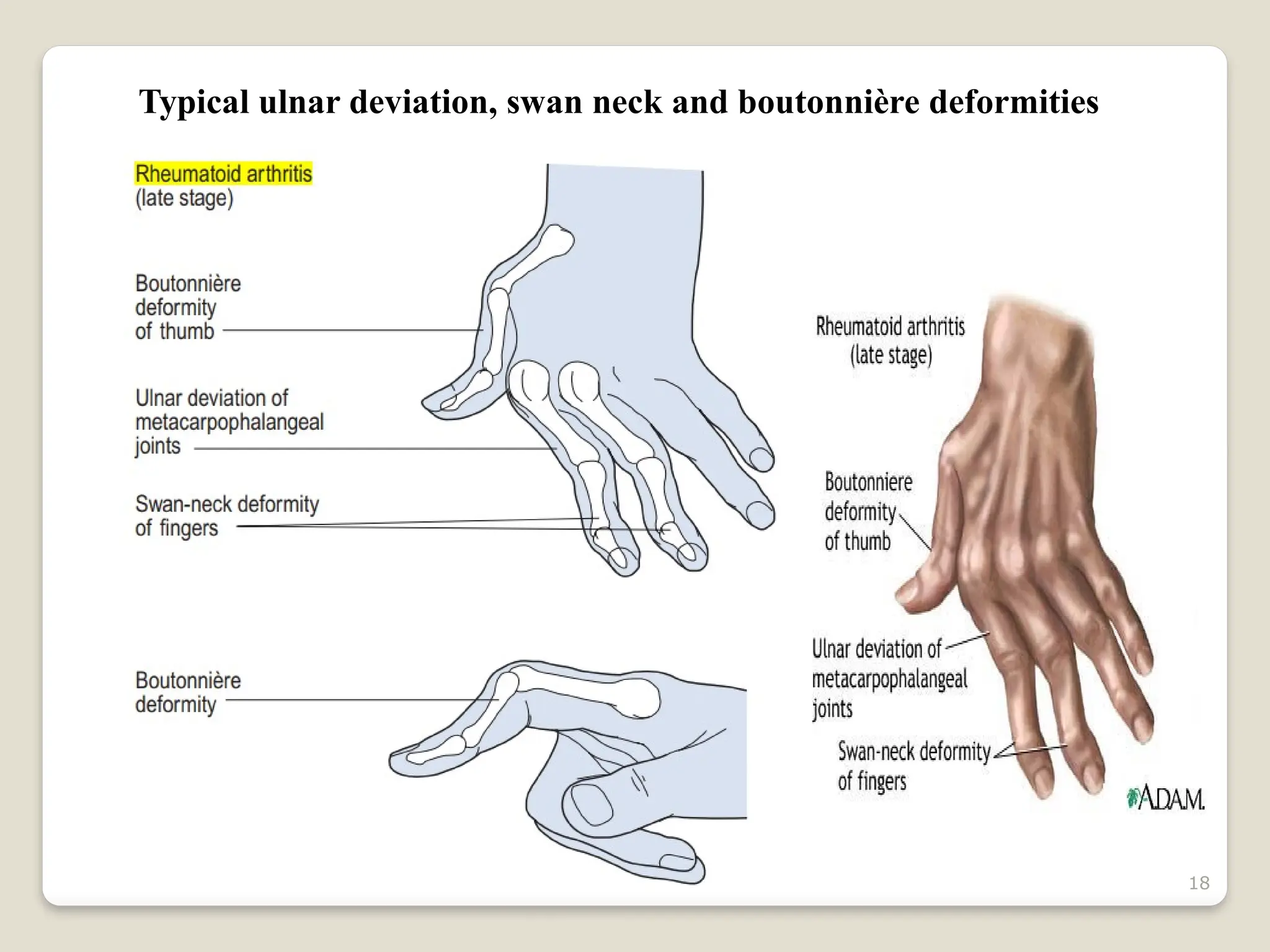 18
Typical ulnar deviation, swan neck and boutonnière deformities
 
