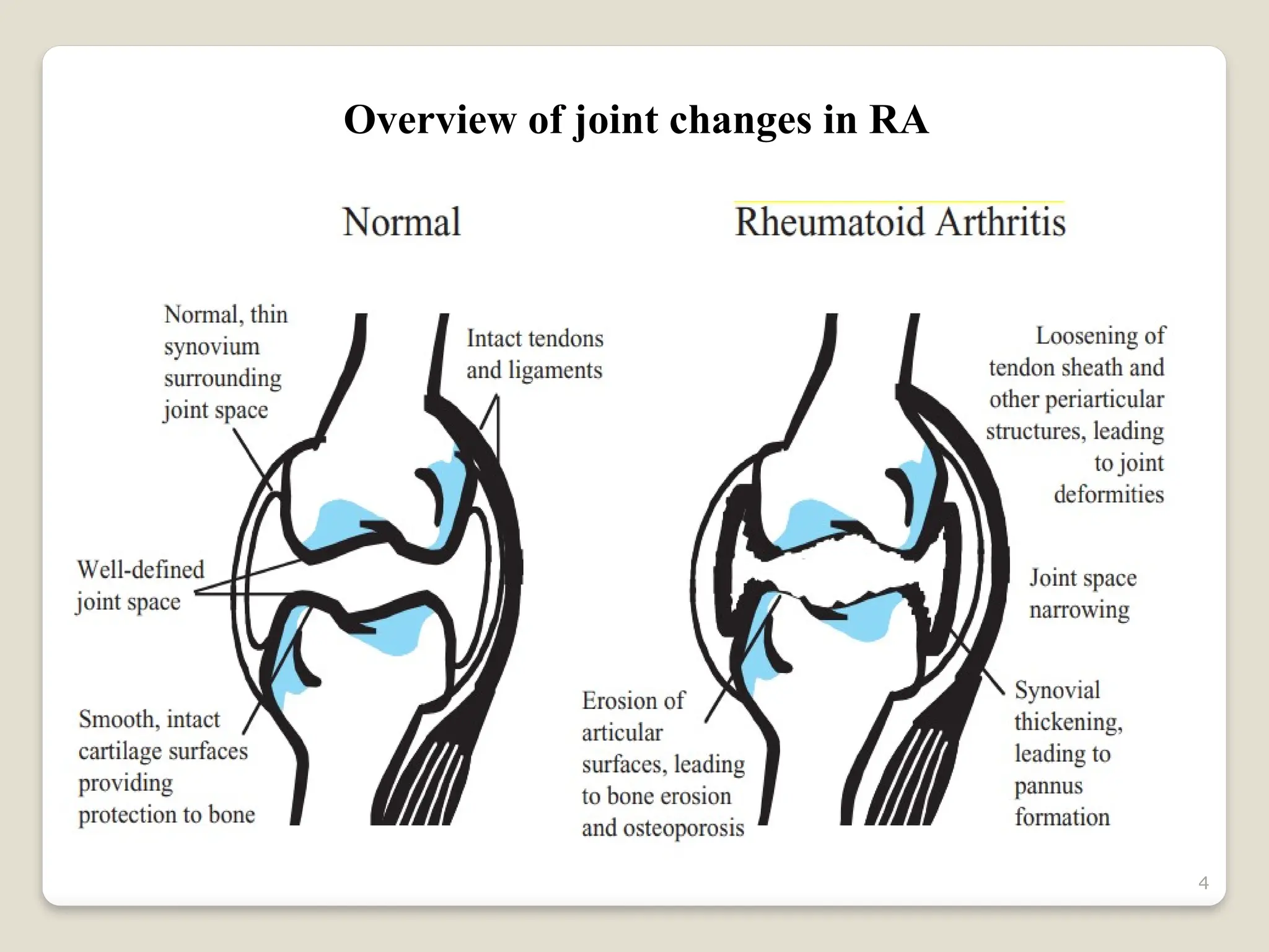 4
Overview of joint changes in RA
 