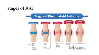 Ra Under Process Rheumatoid Arthritis.The initial goal of therapy is to control and halt ...