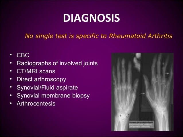 Arthritis singles