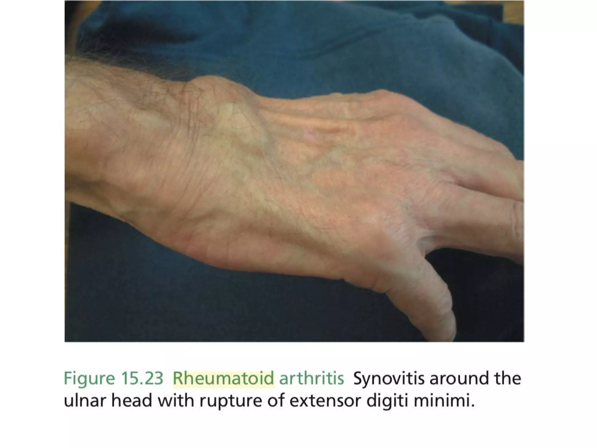 Rheumatoid arthritis | PPTX