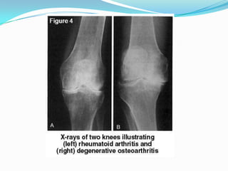 rheumatoid-arthritis-vs-osteoarthritis-x-ray
