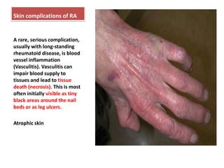 Skin complications of RA<br />