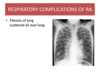 RESPIRATORY COMPLICATIONS OF RA<br />CAPLANS SYNDROME<br />The combination of RA and exposure to coal dust produces the co...