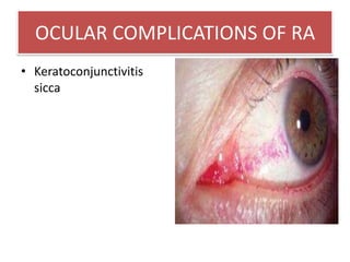 RESPIRATORY COMPLICATIONS OF RA<br />well defined nodules, usually 0.5 - 2.0 cm in diameter, which may cavitate and resemb...