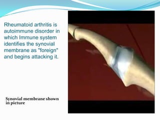 Rheumatoid arthritis isautoimmune disorder in which Immune system identifies the synovial membrane as "foreign" and begins...