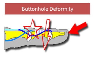 Buttonhole Deformity<br />Flexion of the PIP joint accompanied by hyperextension of the DIP joint .<br />This deformity ca...
