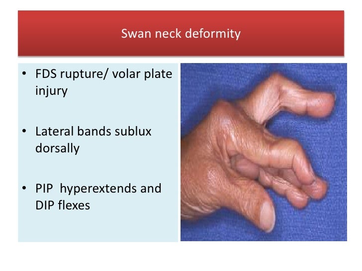 RHEUMATOID ARTHRITIS BY DR BASHIR AHMED DAR ASSOCIATE PROFESSOR MEDIC…