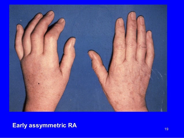 free essay or dissertation about rheumatoid arthritis free dissertation about rheumatoid arthritis
