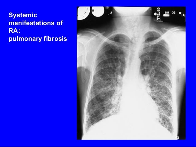 Rheumatoid arthritis dr.abdallah