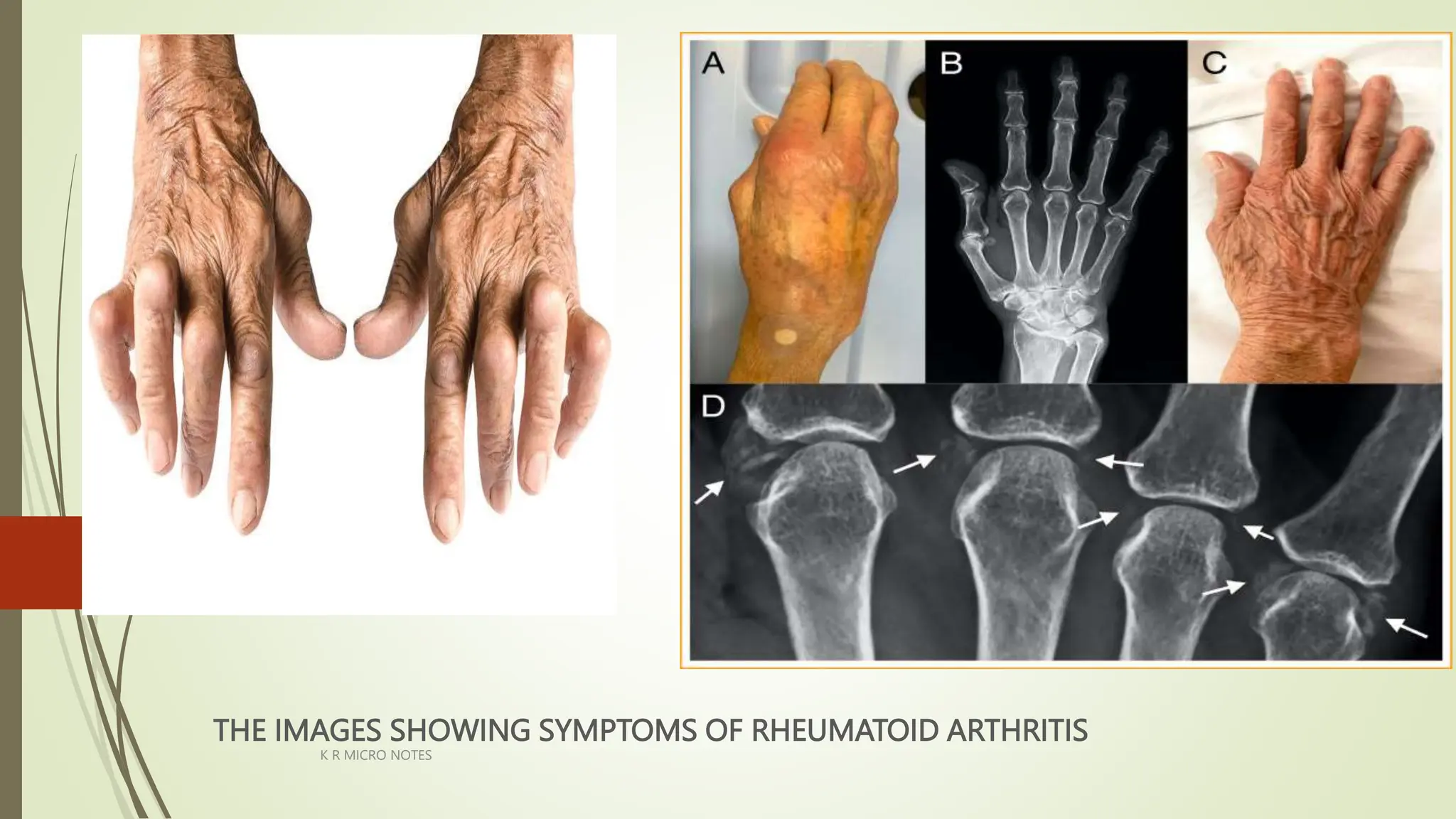 RHEUMATOID ARTHRITIS K R. pptx | PPTX