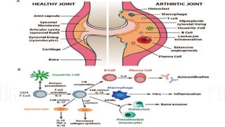Rheumatoid arthritis | PPTX