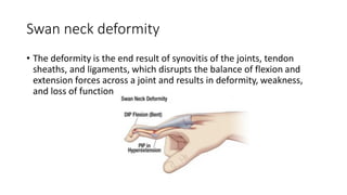 Swan neck deformity
• The deformity is the end result of synovitis of the joints, tendon
sheaths, and ligaments, which disrupts the balance of flexion and
extension forces across a joint and results in deformity, weakness,
and loss of function
 