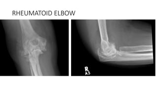 RHEUMATOID ELBOW
 