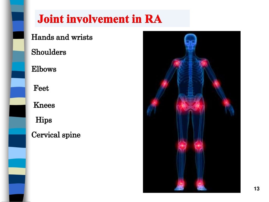 Rheumatoid arthritis ppt by ann..