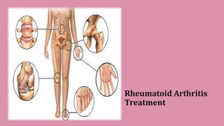Rheumatoid Arthritis
Treatment
 