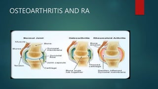 RHEUMATOID ARTHRITIS. | PPTX
