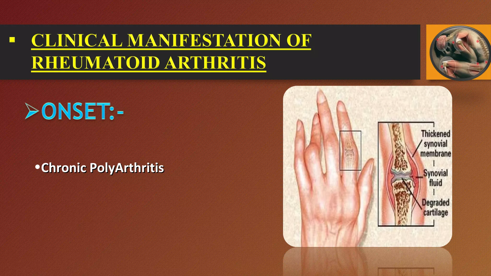 Rheumatoid arthritis with homoeopathy approach by Dr.Ankit Srivastav | PPS