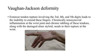 Rheumatoid hand, Orthopaedics Dr Amal jose.pdf