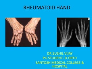 RHEUMATOID HAND




        DR.SUSHIL VIJAY
      PG STUDENT- D ORTH
   SANTOSH MEDICAL COLLEGE &
           HOSPITAL
 