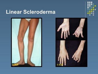 Rheumatologic Diseases of the body in Paediatric Population | PPTX