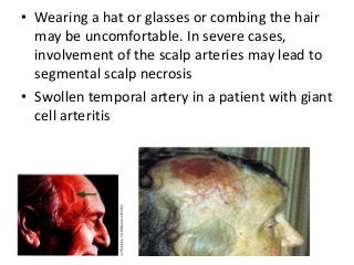 • Wearing a hat or glasses or combing the hair
may be uncomfortable. In severe cases,
involvement of the scalp arteries may lead to
segmental scalp necrosis
• Swollen temporal artery in a patient with giant
cell arteritis
 
