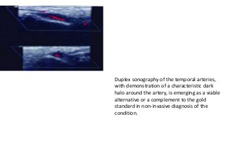 Duplex sonography of the temporal arteries,
with demonstration of a characteristic dark
halo around the artery, is emerging as a viable
alternative or a complement to the gold
standard in non-invasive diagnosis of the
condition.
 
